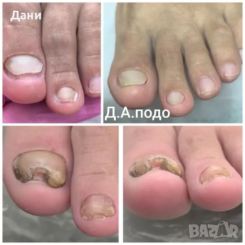 медицински педикюр 